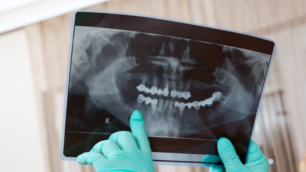 Dental XRays Open Wide La Jolla Dentistry