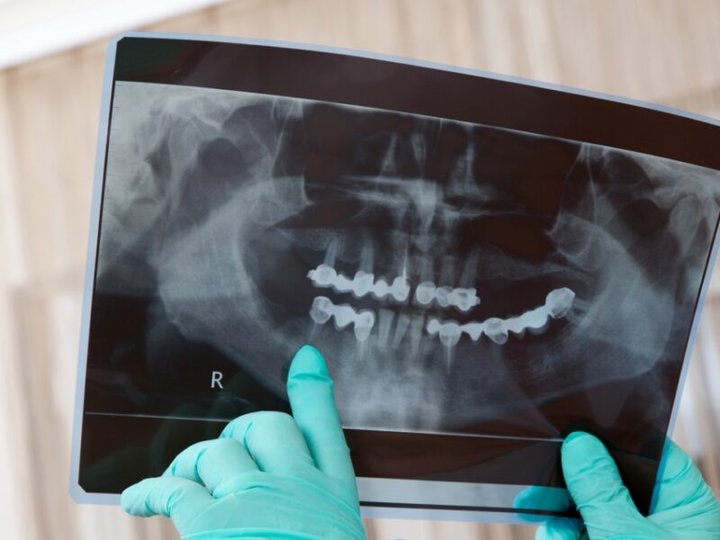 Pediatric Dental X-Rays