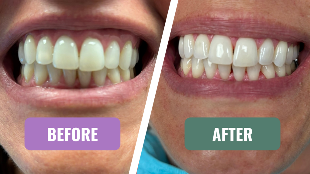 Guided Biofilm Therapy teeth cleaning in La Jolla, CA. Before and After.