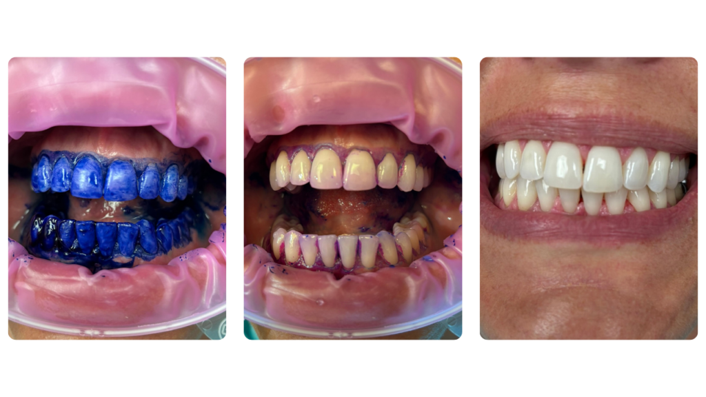 An organic dye highlights plaque (also known as dental biofilm) so the hygienist can clean and remove it more accurately.